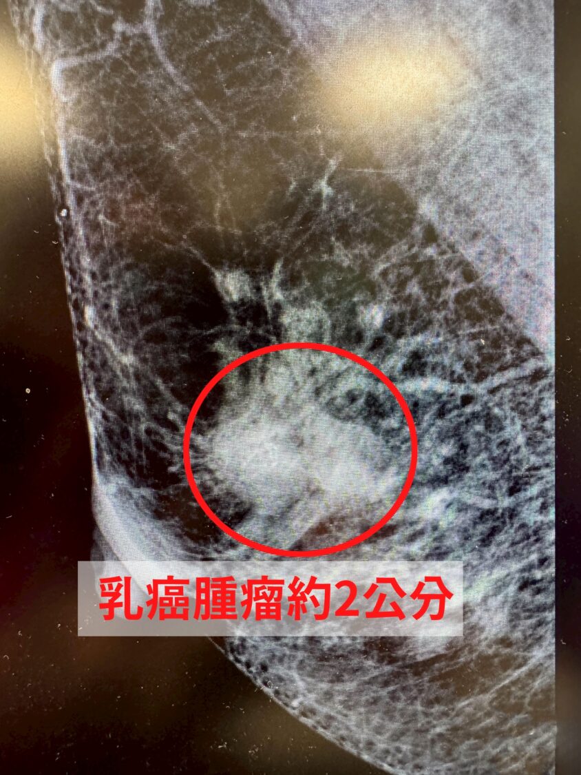 乳房影像檢查顯示乳頭下方腫瘤約2公分，經穿刺切片確診為乳癌第二期，提醒女性若乳頭異常滲液、濕疹不癒應儘早就醫。（圖/記者張家燁翻攝）