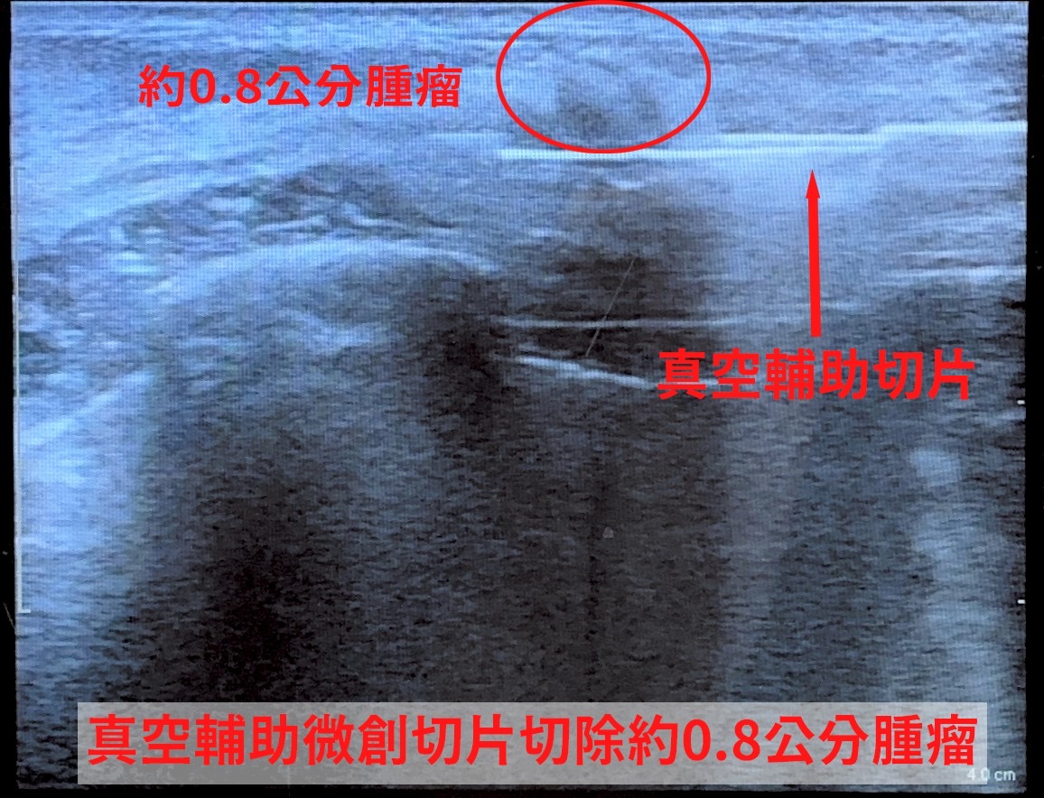 真空輔助微創切片影像示意圖，可見約0.8公分的乳房腫瘤，透過真空輔助微創切片完整移除病灶，達到診斷與治療雙重目的。（圖/記者張家燁翻攝）