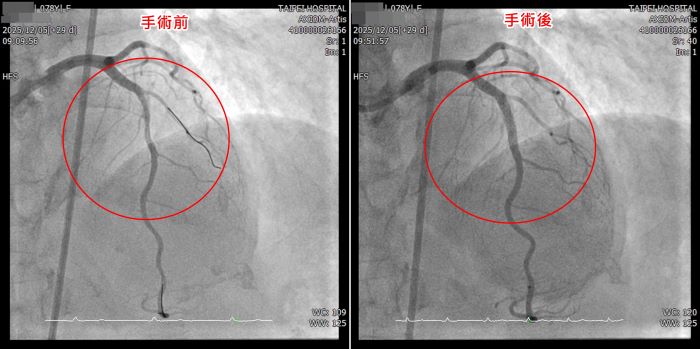 介入治療新紀元 臺北醫院引進「血管內震波碎石術」 5 《圖說》左圖為治療前左前降支嚴重鈣化狹窄、血流受阻;右圖經血管內震波碎石術與支架置放後,血管成功擴張,血流明顯改善。〈臺北醫院提供〉