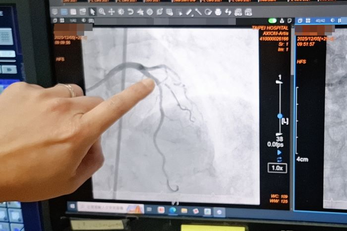 介入治療新紀元 臺北醫院引進「血管內震波碎石術」 6 《圖說》自引進「血管內震波碎石術」,臺北醫院心臟內科已順利完成超過17例高難度冠狀動脈鈣化導管手術。〈臺北醫院提供〉