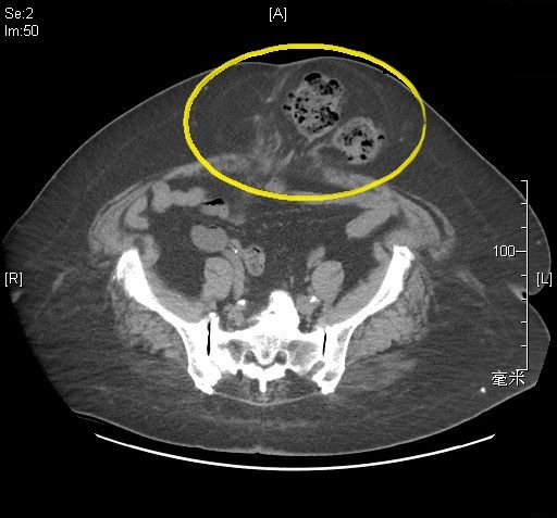 術後疤痕鼓起別輕忽 腹壁切口疝氣恐引發腸阻塞 4 《圖說》黃崧峰醫師說明,電腦斷層影像顯示腹部手術傷口處出現疝氣,導致腸道突出(黃圈處),增加手術難度及病患術後恢復的天數。〈土城醫院提供〉