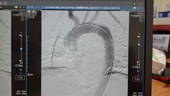胸部鈍挫傷恐致主動脈破裂 醫:死亡率高達八成需及早診斷 7 《圖說》展開主動脈腔內血管支架置放手術,封堵出血點。〈臺北醫院提供〉