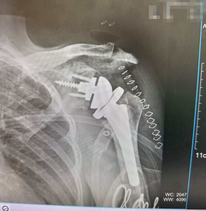 術前3D模擬助攻 臺北醫院肩關節置換手術更精準安全 48 《圖說》反式人工肩關節手術,改善長期肩關節退化合併旋轉肌嚴重破裂。〈臺北醫院提供〉