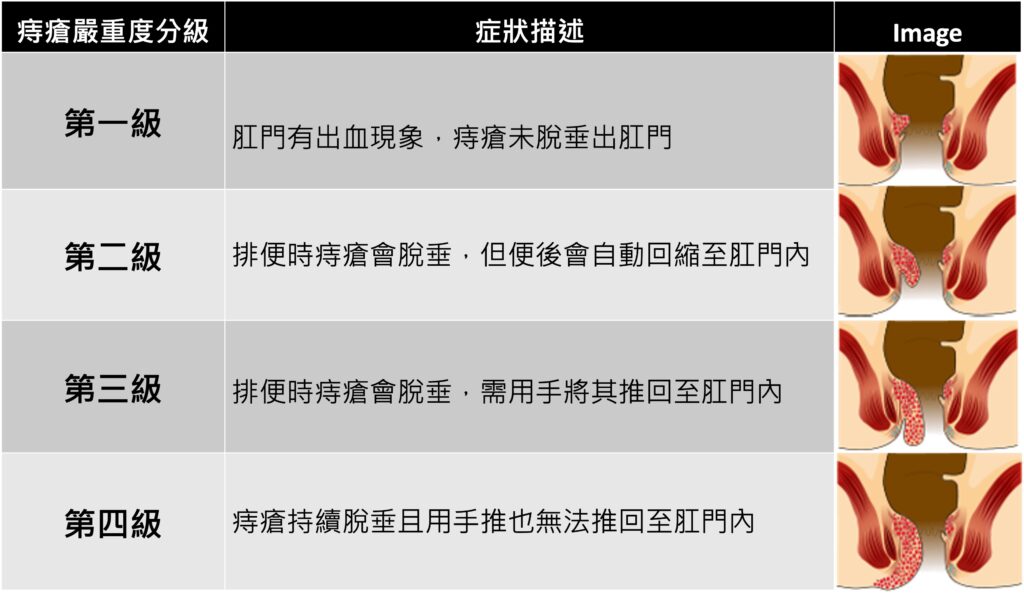 痔瘡反覆出血脫垂不用怕 最新微創雷射無限環技術邁入精準收縮無痛新紀元 54 %E5%9C%96%E7%89%87 1